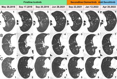 Case report: Different mechanisms of drug resistance in a synchronous multiple primary lung cancer patient after EGFR-TKI treatment